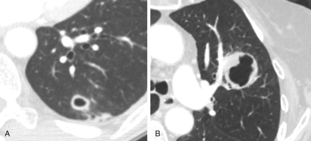 FIGURE 22.5, Cavitary nodules. Computed tomography images demonstrating cavitary nodule with smooth wall, which tends to be more typical in benign lesions such as this case of biopsy-proven Mycobacterium avium-intracellulare infection (MAI) (A) and cavitary lesion with thick and irregular walls, which are more common with primary and metastatic tumors such as this squamous cell carcinoma (B) .