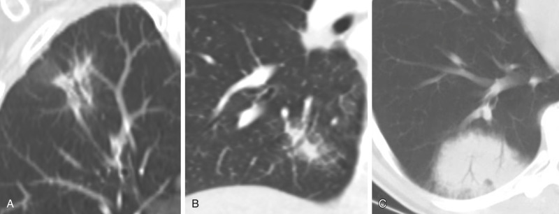 FIGURE 22.7, Air bronchogram. Coronal chest computed tomography reformats demonstrate two examples of subsolid nodules demonstrating prominent air bronchograms, also known as the “bronchus sign.” One was an invasive adenocarcinoma in the right upper lobe (A) , and the other was a lymphoma in the right lower lobe (B) . A focal infection can also have this appearance, in this case, rounded pneumonia (C) .