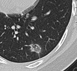 FIGURE 22.8, Reverse halo sign. Axial chest computed tomography image demonstrates a nodular area of ground glass in the left lower lobe with surrounding rim of soft tissue density consistent with a “reverse halo sign” in this patient with organizing pneumonia.