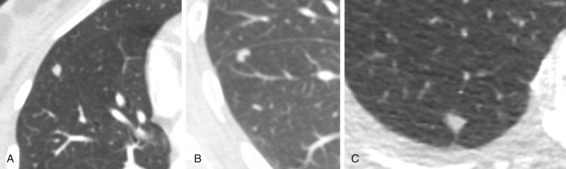 FIGURE 22.9, Intraparenchymal lymph nodes. Computed tomography images demonstrate an oval-shaped nodule adjacent to the right minor fissure (A) , a kidney-bean–shaped nodule adjacent to the major fissure (B) , and a triangular nodule associated with an interlobular septum extending to the pleural surface (C) . Perifissural location and association with an interlobular septum are characteristic features of benign intraparenchymal lymph nodes.