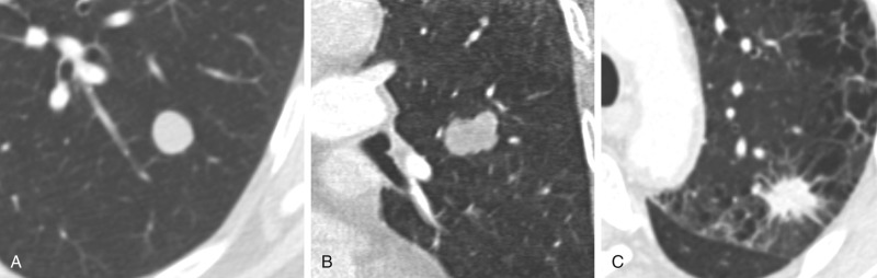 FIGURE 22.10, Nodule margins. Computed tomography images demonstrating examples of smooth margins of a nodule, in this case a benign metastasizing leiomyoma (A) , lobulated margins in a melanoma metastasis (B) , and spiculated margins in a lung adenocarcinoma (C) .