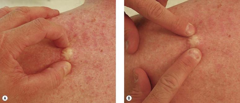 FIGURE 12.1, (A) Palpation of subcutaneous growth with thumb and forefinger to help delineate margins prior to surgery. (B) Palpation of subcutaneous mass with two forefingers may help further to detect surrounding fibrosis and mobility of the subcutaneous growth.