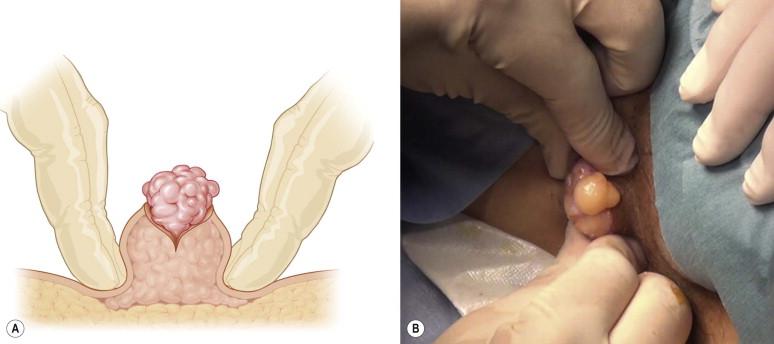 FIGURE 12.3, Technique for application of firm finger pressure around lipoma (or cyst) to deliver it through the incision.