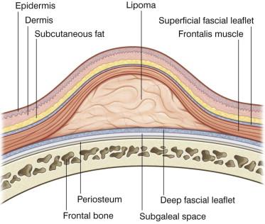 FIGURE 12.4, Lipoma: important anatomic structures.