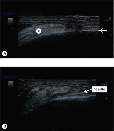 FIGURE 12.5, Ultrasonography images. (A) Frontalis-associated lipoma indicated by “a” is adherent to the periosteum (arrow). (B) Injection of local anesthesia dissects lipoma from periosteum.