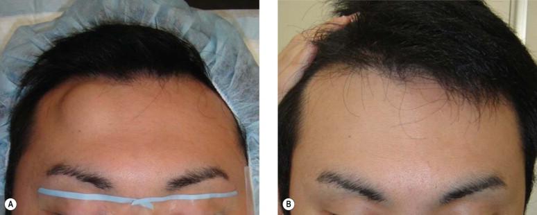 FIGURE 12.6, (A) Frontalis-associated lipoma. (B) The tumor could be treated with no scar directly above the tumor by making an incision in the hairline.