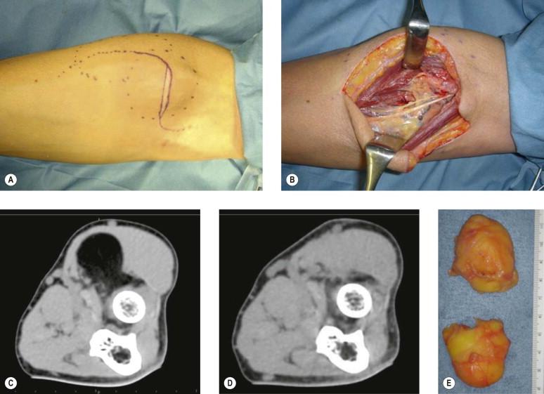 FIGURE 12.7, (A) The design is prepared to include the scar in the resection. (B) Intraoperative demonstration of depth of lipoma. (C) Preoperative CT image with opaque area of tumor. (D) Postoperative CT image. (E) Extracted lipoma in two parts.