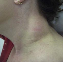 FIGURE 12.8, The expanding mass on the left neck made it difficult for this 45-year-old woman to turn her head. At the time of resection of the mass, the lipoma was found to be interspersed with soft tissue, muscle, blood vessels, and the spinal accessory nerve. During surgery by a head and neck surgeon, the spinal accessory nerve was explored and found to run within the lipoma. The nerve was preserved.