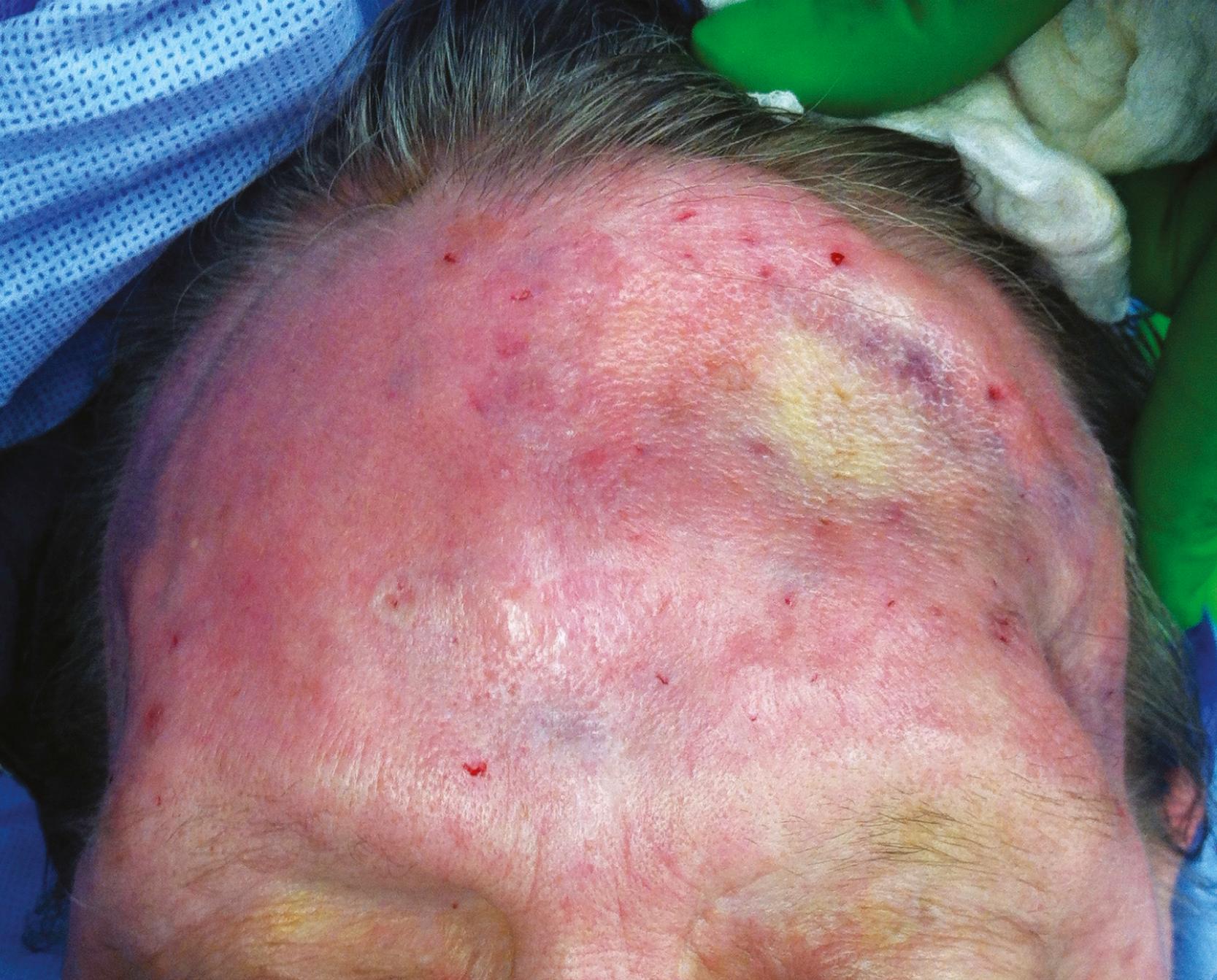 Figure 23.3, A patient with a history of anterior fossa tumor with titanium mesh reconstruction and a history of radiation with residual radiation changes to the skin.