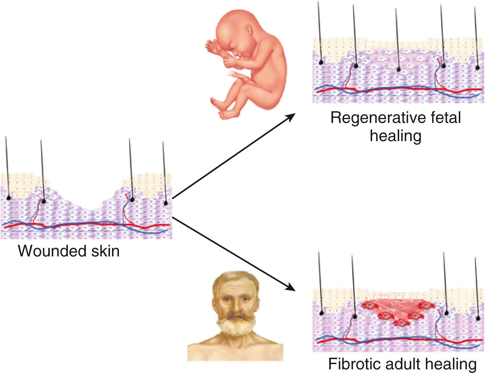 Figure 23.4, Fetal skin heals back to its original state without forming scar, unlike fibrotic adult wound healing.