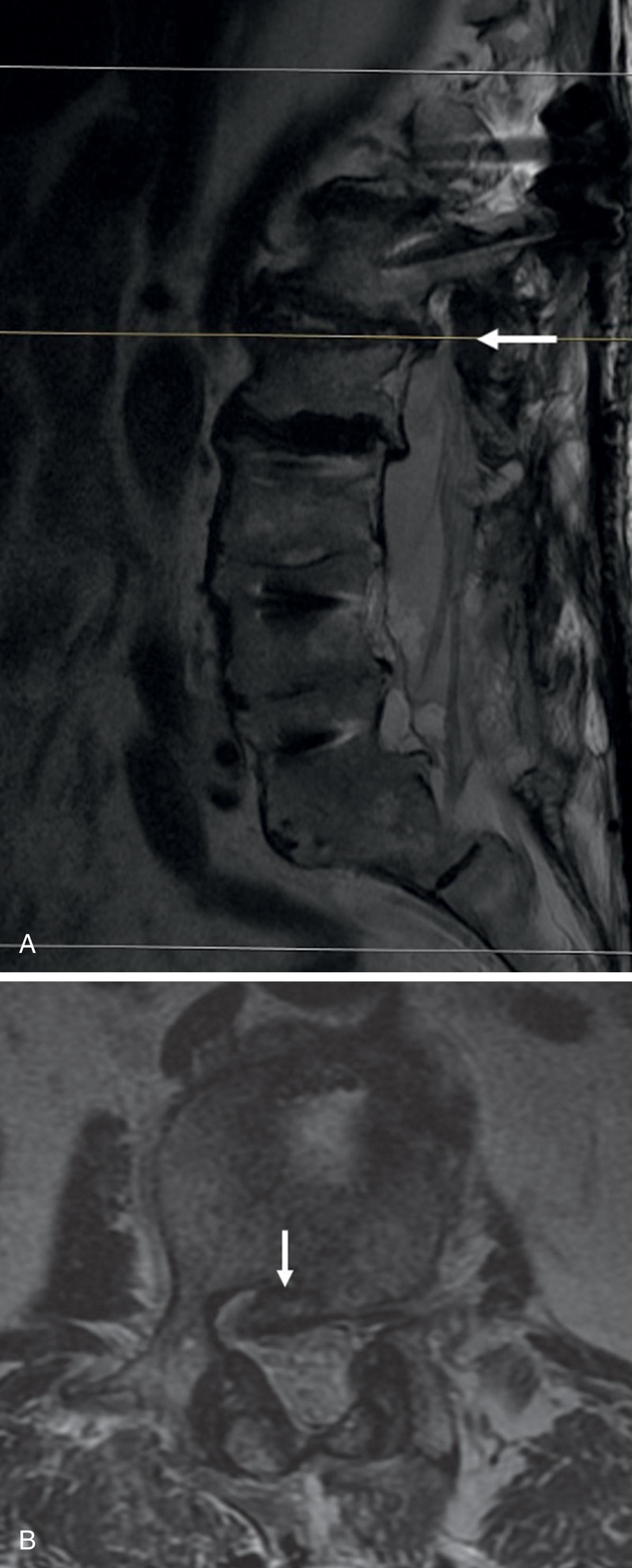 Fig. 4.1, (A), (B) A 74-year-old man with prior T12–L1 and L3–S1 fusions presenting with neurogenic claudication and adjacent segment degeneration with disc space collapse and lumbar stenosis at the L1–L2 level above and below the prior fusion levels (see white arrows ).