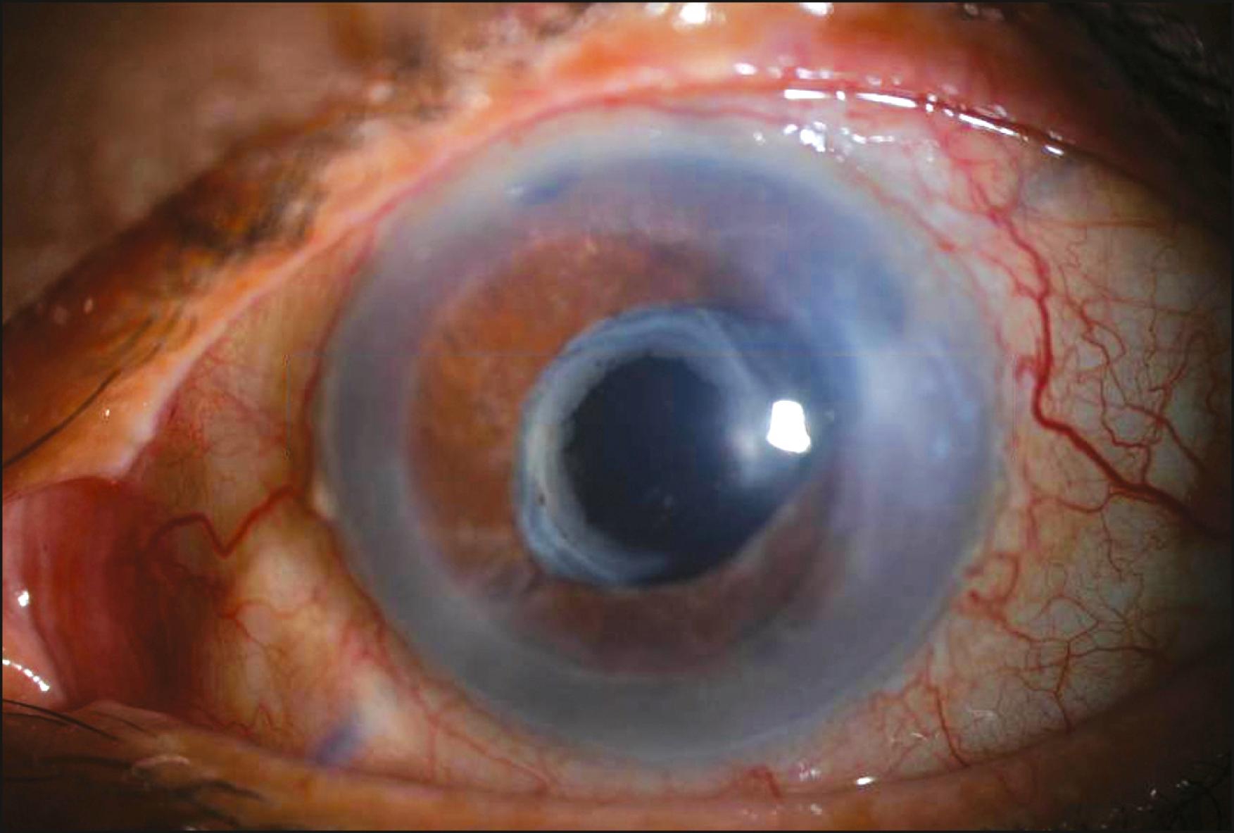 Fig. 128.1, Descemet stripping automated endothelial keratoplasty (DSAEK) in an eye that has undergone multiple glaucoma procedures including a trabeculectomy (note the superior surgical peripheral iridectomy) and two glaucoma drainage devices (inferonasally and superotemporally). Note that even in the most challenging of eyes, DSAEK can be successfully performed.