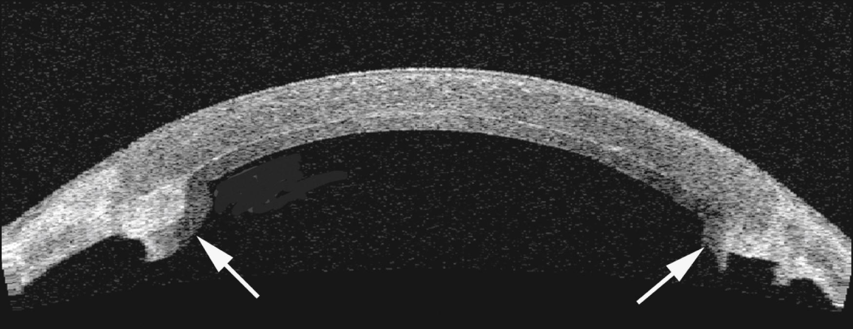 Fig. 128.2, Anterior segment optical coherence tomography image of Descemet stripping endothelial keratoplasty performed to treat a failed penetrating graft.