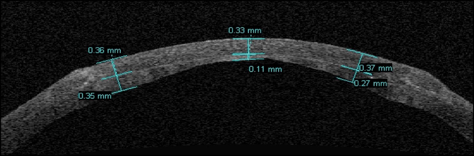 Fig. 118.2, Femtosecond laser-assisted anterior lamellar keratoplasty in advanced keratoconus: postoperative anterior segment optical coherence tomography shows an inhomogeneous residual bed thickness.