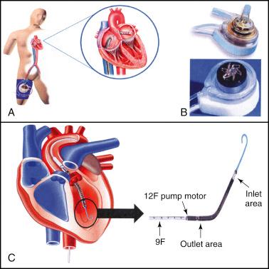 eFig. 1.1, Devices that are increasingly available to provide assistance during high-risk percutaneous coronary intervention include percutaneous extracorporeal circulatory support devices such as the TandemHeart (A and B) and the Impella device (C). (A) The TandemHeart removes oxygenated blood from the left atrium and returns this blood into the peripheral arterial circulation; with the (B) aid of a centrifugal pump. (C) The Impella left ventricular assist device is a miniaturized rotary blood pump that is placed retrograde across the aortic valve, and it aspirates ( inlet area ) up to 2.5 L/min of blood from the left ventricular cavity and subsequently expels this blood ( outlet area ) into the ascending aorta.