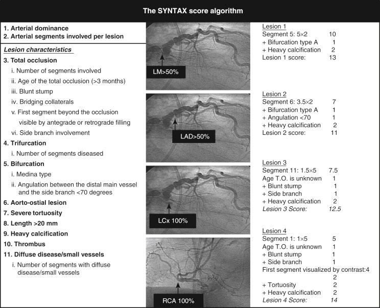 Fig. 1.5, The SYNTAX score algorithm is applied to each individual coronary lesion in a vessel larger than 1.5 mm in diameter that has a stenosis diameter greater than 50%; the individual lesion scores are added together to give the final SYNTAX score. 16 45 46 47 LAD , Left anterior descending; LCx , left circumflex artery; LM , left main; RCA, right coronary artery.