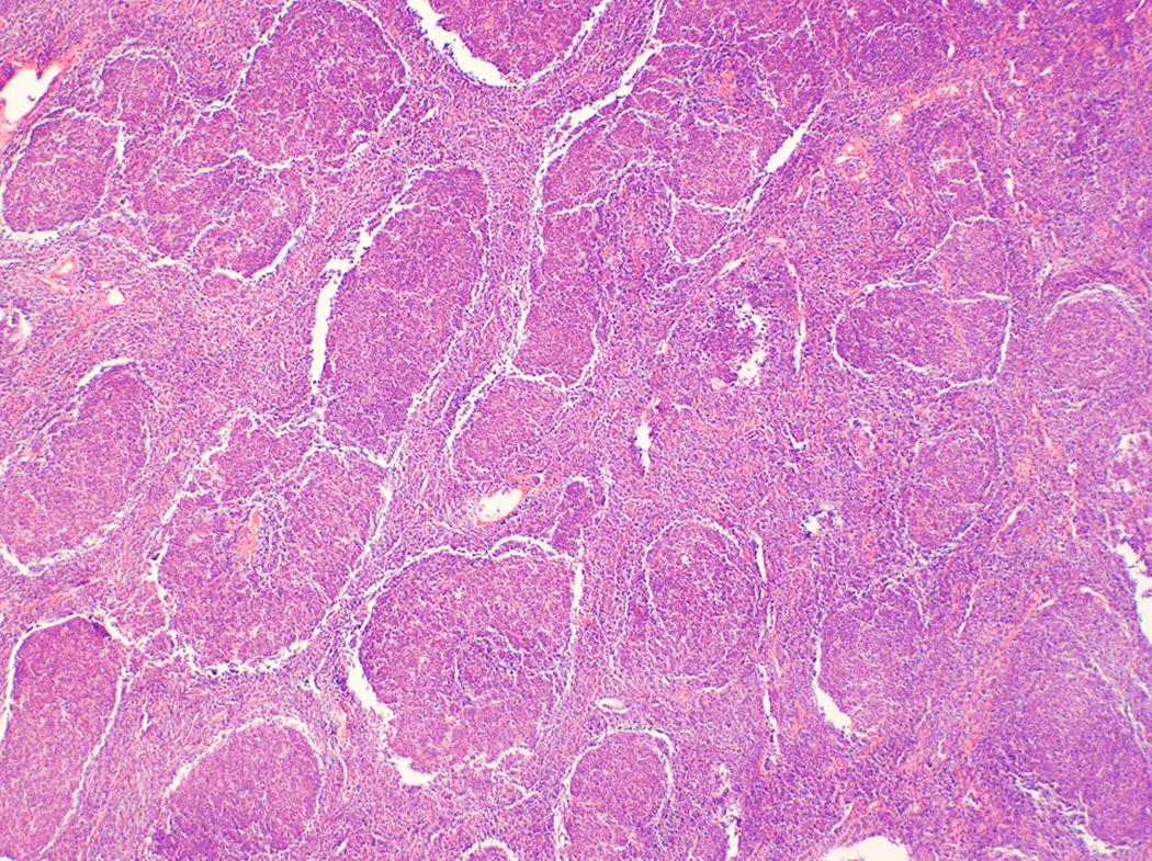 Fig. 12.1, Low-grade follicular lymphoma (World Health Organization grade 1–2) demonstrating a classic nodular appearance on cut section of a lymph node biopsy specimen. Artifactual tissue cracking is commonly seen (×2 objective).