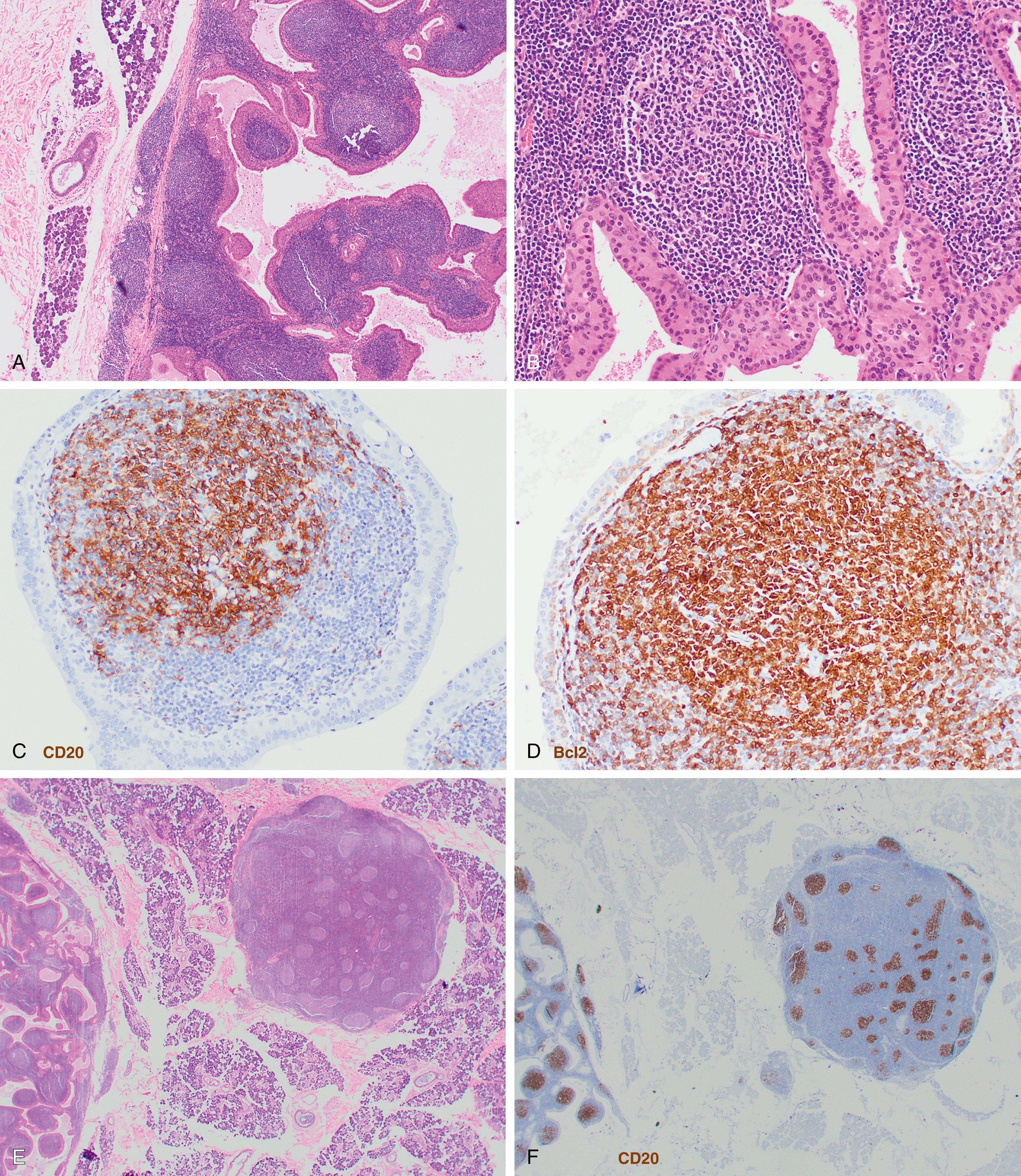 Fig. 12.2, Low-grade follicular lymphoma extensively involving a Warthin tumor in the salivary gland (A–D) as well as an adjacent lymph node (E–G). Images A and E–G were taken with ×4 objective. Images B–D with 20x. The follicular cells coexpress CD20 (C and F) and BCL2 (D and G).