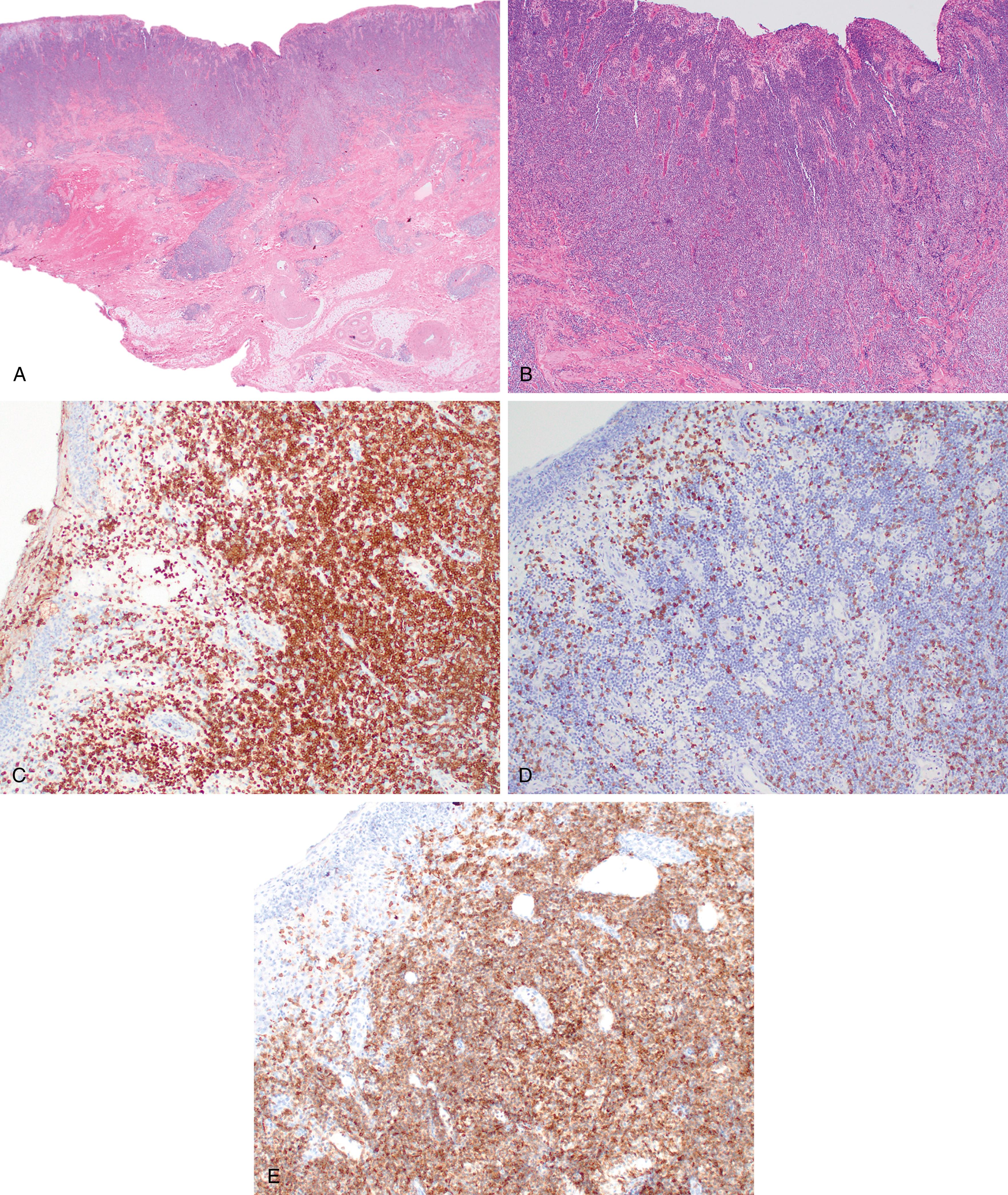 Fig. 12.4, Chronic lymphocytic leukemia/small lymphocytic lymphoma. An elderly female patient with massive involvement of the labia by chronic lymphocytic leukemia and small lymphocytic lymphoma with extensive ulceration and clinical presentation concerning for a herpetic lesion or squamous cell carcinoma. Hematoxylin-eosin stain (A, ×1.25; B, ×4) and immunohistochemistry for CD79a (C), CD3 (D), and CD5 (E) taken with the 10x objective.