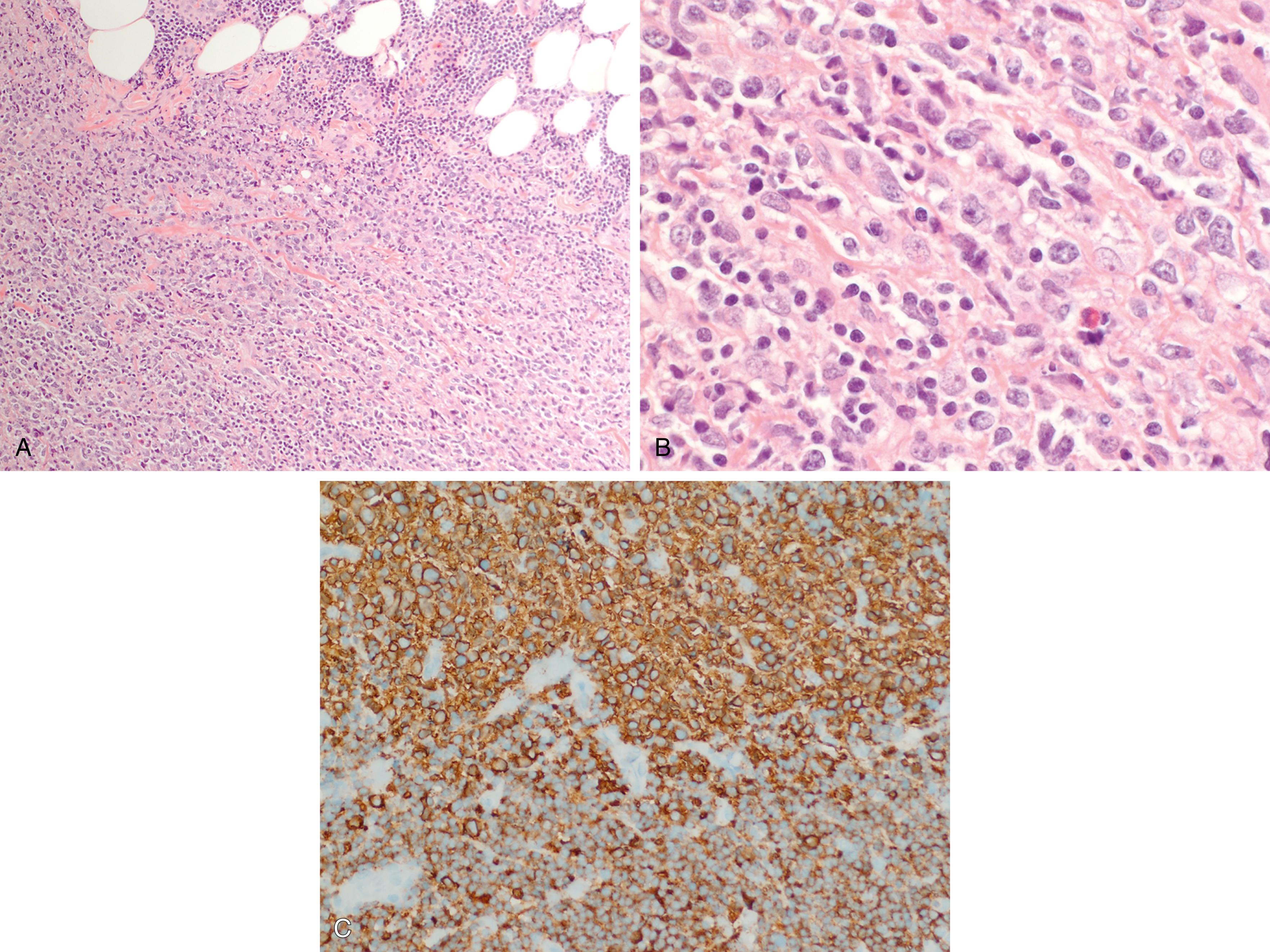 Fig. 12.6, Richter’s transformation to diffuse large B cell lymphoma (A–C). Sections from a cholestectomy specimen show a residual small lymphocytic proliferation consistent with chronic lymphocytic leukemia/small lymphocytic lymphoma infiltrating portions of adipose tissue (A, ×10 objective, top right), which show dim expression of CD20 (C, ×20 objective, bottom half). There is a relatively well-demarcated expansion of large, atypical lymphoid cells with vesicular nuclei (B), which show stronger CD20 staining (C, top half ).