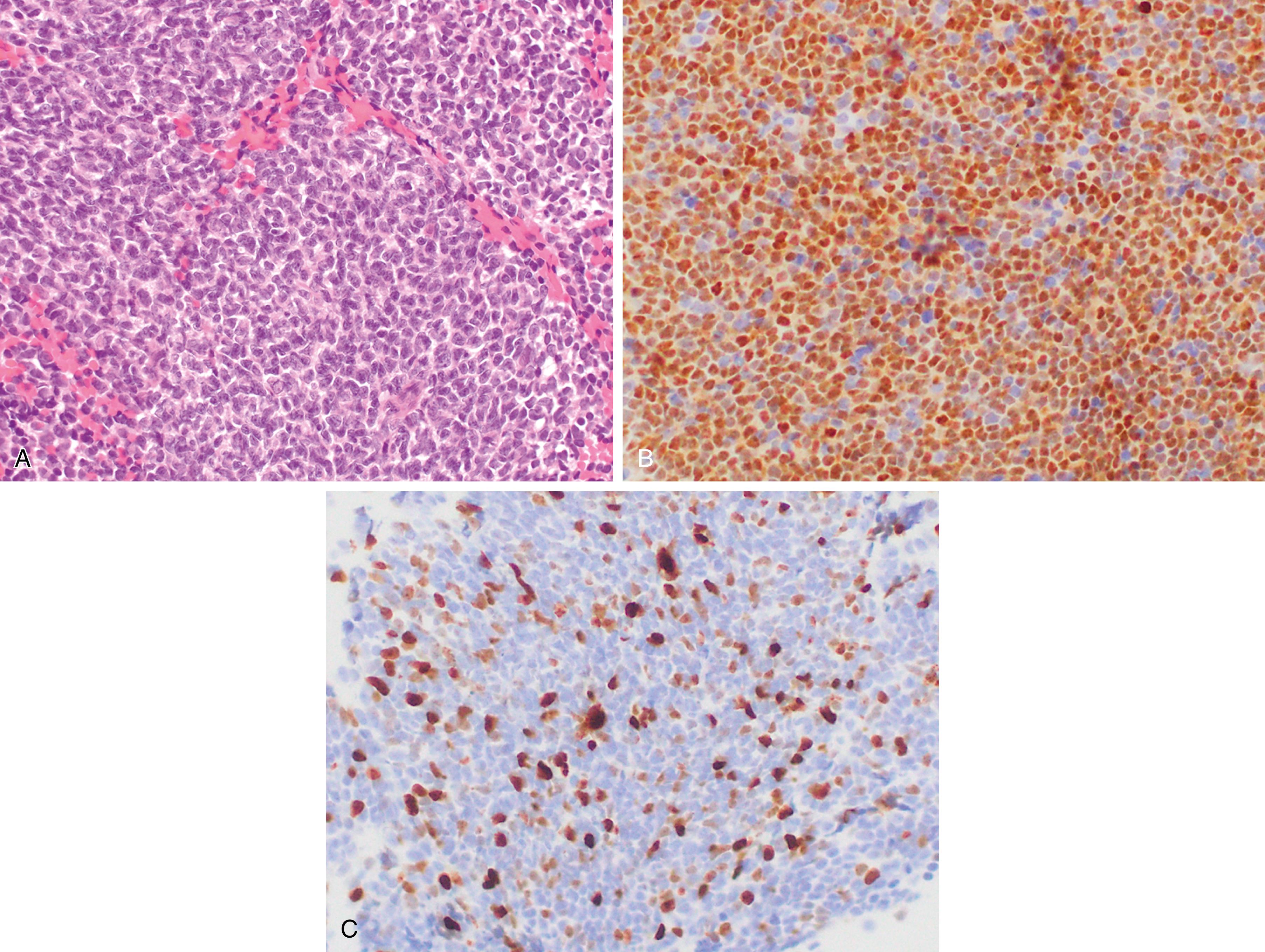 Fig. 12.7, Mantle cell lymphoma. (A) A relatively monotonous proliferation of small lymphoid cells is seen in sections generated from a fine-needle aspirate cell block (hematoxylin-eosin stain). The atypical cells are diffusely positive for cyclin D1 (B). The Ki67 proliferation rate has important prognostic considerations, here low (C). All images taken with ×40 objective.