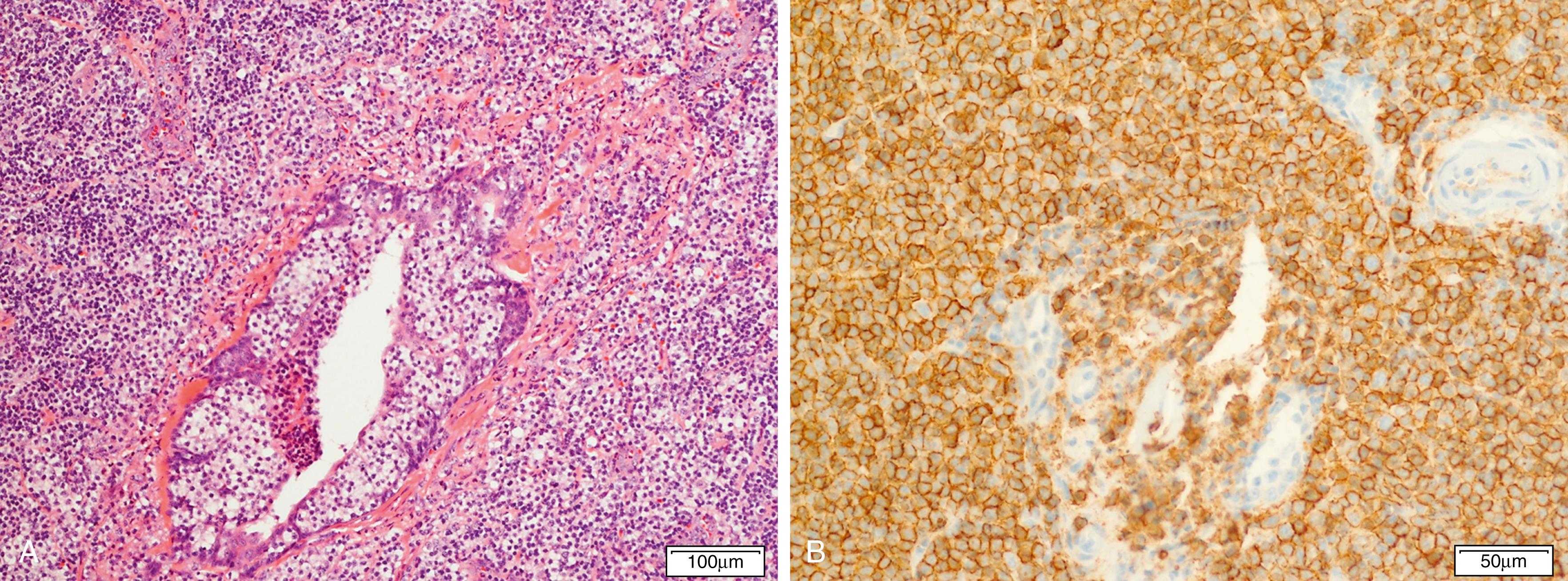 Fig. 12.9, Mucosa-associated lymphoid tissue lymphoma creating a striking lymphoepithelial lesion within the salivary gland epithelium (A). The cells demonstrate a distinct monocytoid appearance. The tumor cells are diffusely positive for CD20 (B). Both images taken with ×20 objective.