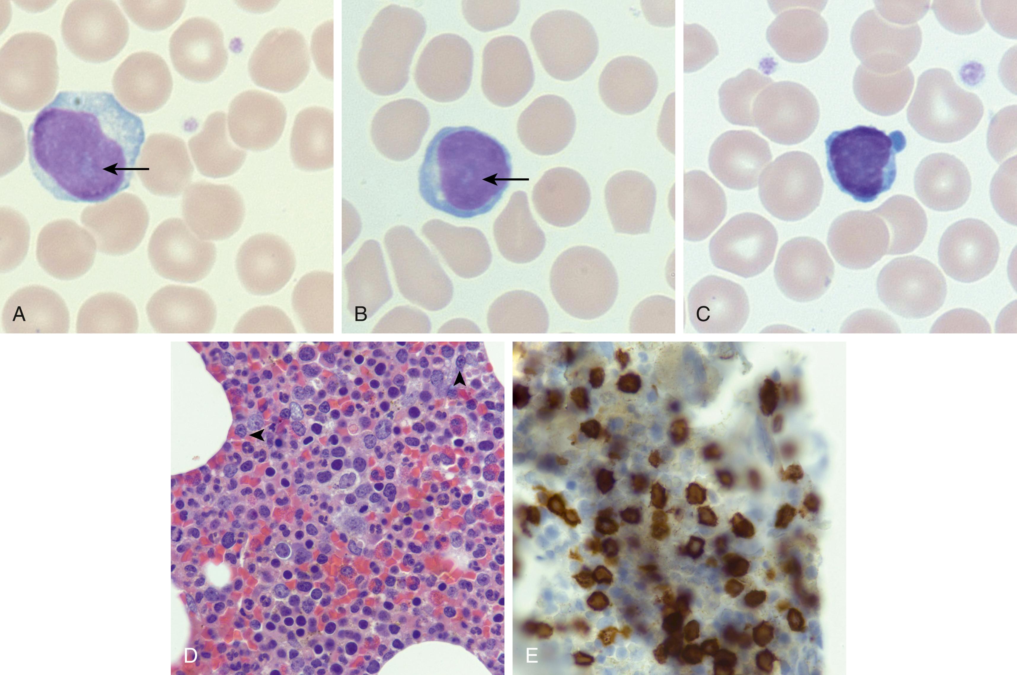 Fig. 13.1, T-prolymphocytic leukemia (T-PLL) in peripheral blood and bone marrow. (A, B) Image of T-PLL cells circulating in the peripheral blood. These cells have slightly immature nuclear chromatin with prominent nucleoli. The arrows denote the large, more centrally located nucleolus. (C) Image of the small cell variant of T-PLL where neoplastic cells do not show prominent nucleoli; notice the cytoplasmic blebbing in this case. (D) Bone marrow core biopsy specimen with morphologically subtle involvement by T-PLL cells ( arrowhead ); these neoplastic cells show prominent single nucleoli as in the peripheral blood. (E) A CD3 stain highlights T-PLL cells in the marrow that appear larger in size.