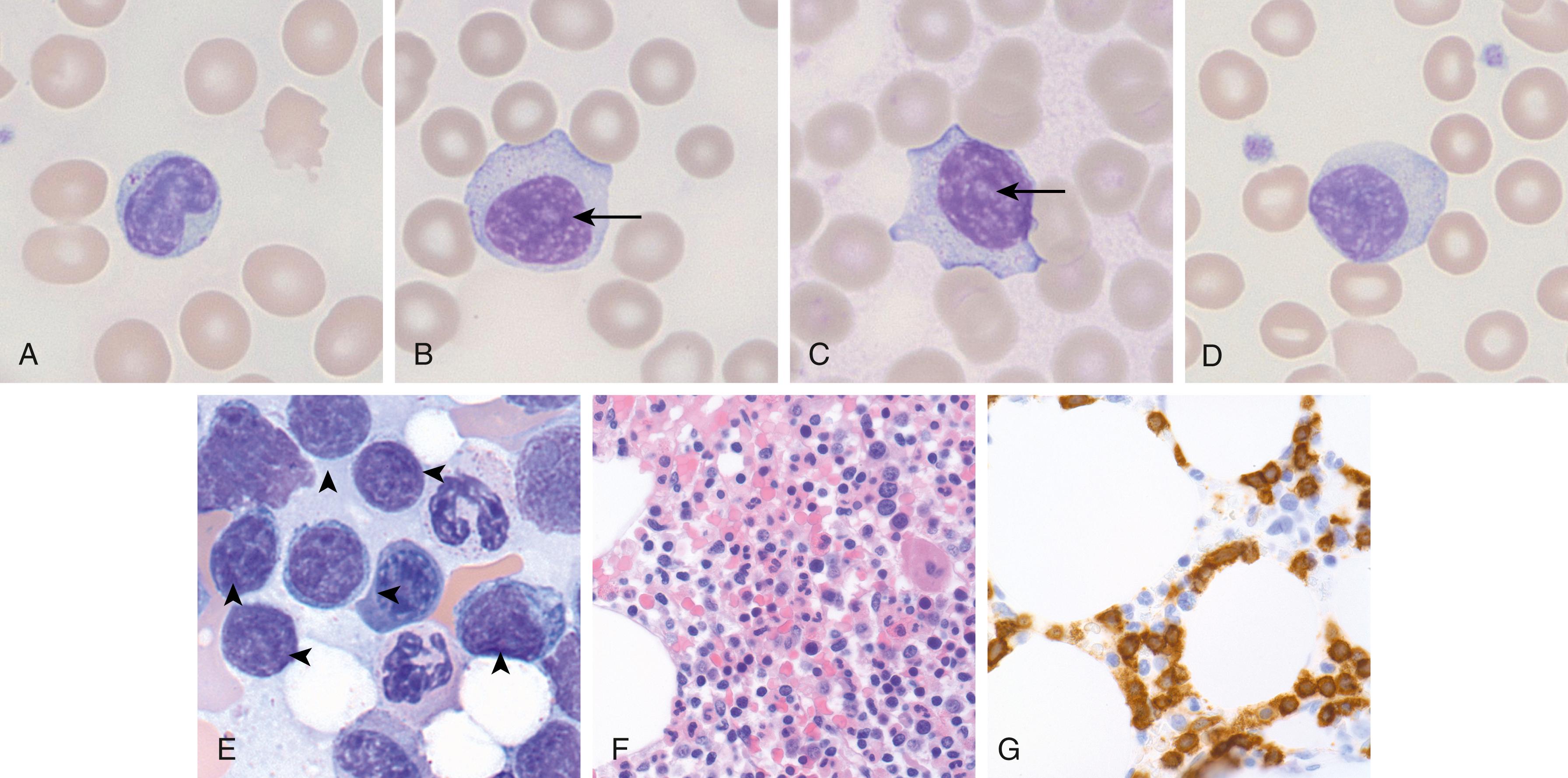 Fig. 13.2, T-cell large granular lymphocytic (T-LGL) leukemia. (A–D) Images of large LGLs with large nuclei with moderately condensed nuclear chromatin. Some nuclei show visible nucleoli ( arrows ); cytoplasmic azurophilic granules of varying prominence are seen in all cases. (E) LGLs in a marrow aspirate that are medium to larger in size with minimal amounts of cytoplasm ( arrowheads ); cytoplasmic granules are typically difficult to see in LGLs in bone marrow aspirate specimens. (F) Bone marrow core biopsy specimen where infiltration by LGLs is not easily apparent. (G) A CD8 immunohistochemical stain highlights numerous LGLs that form large clusters, some in a linear array consistent with a sinusoidal distribution.
