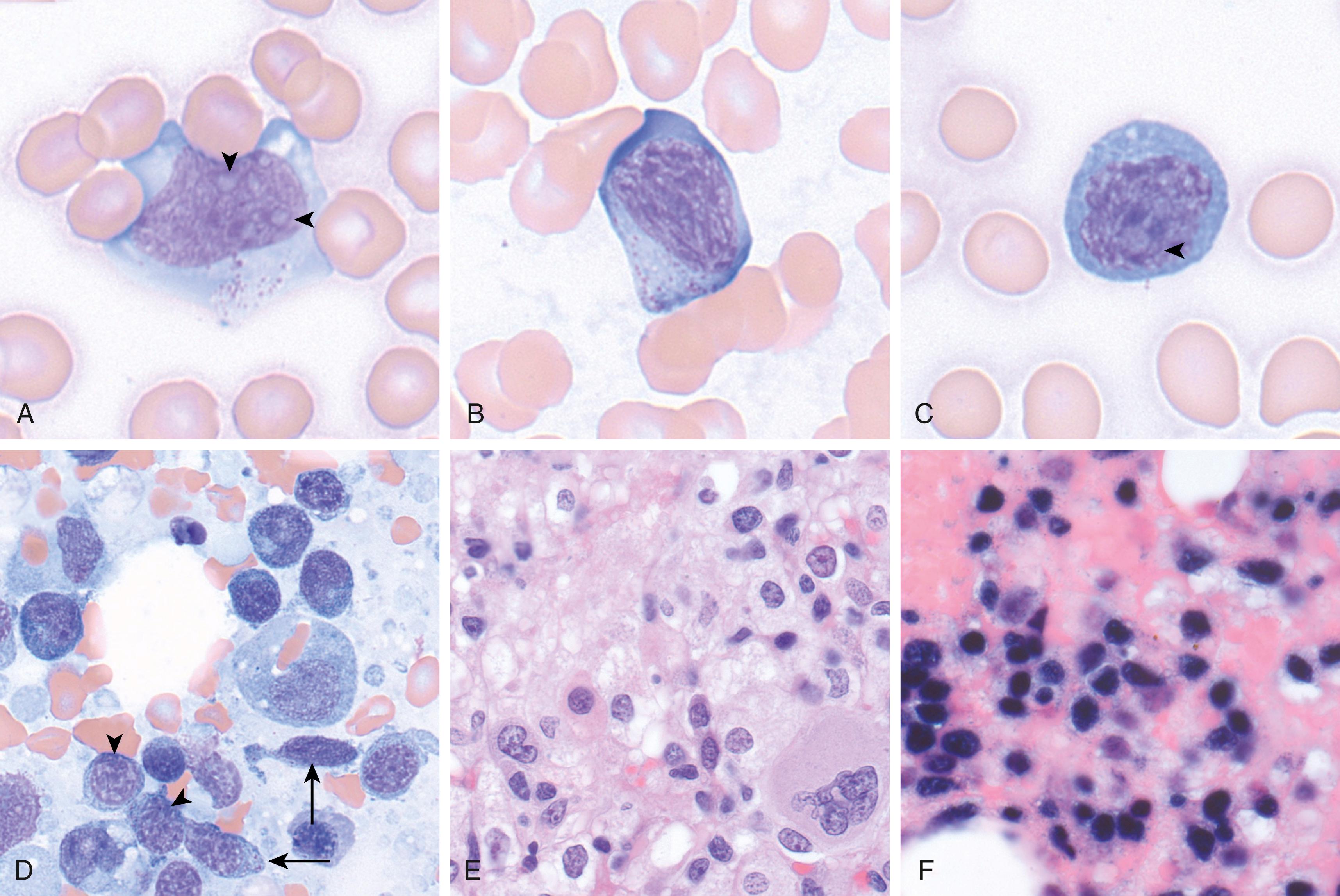 Fig. 13.3, Aggressive natural killer–cell leukemia (ANKL). (A–C) Peripheral blood images of circulating ANKL cells. (A) Neoplastic cells show blastic/immature chromatin with multiple nucleoli ( arrowheads ) and cytoplasmic granules. (B) Features can vary with ANKL cells showing more mature nuclear chromatin and cytoplasmic granules. (C) In some instances, cytoplasmic cytotoxic granules are not clearly seen, although the nucleus is irregular with a prominent nucleolus ( arrowhead ). (D) In bone marrow aspirate slides the ANKL cells may be elongated ( arrows ) with distinctive cytoplasmic granules. Other cells may be more round or oval in appearance but larger in size with small or large cytoplasmic extensions ( arrowheads ). (E) Bone marrow core biopsy specimen with infiltration by ANKL. (F) An Epstein-Barr encoding region in situ hybridization stain is positive in ANKL.