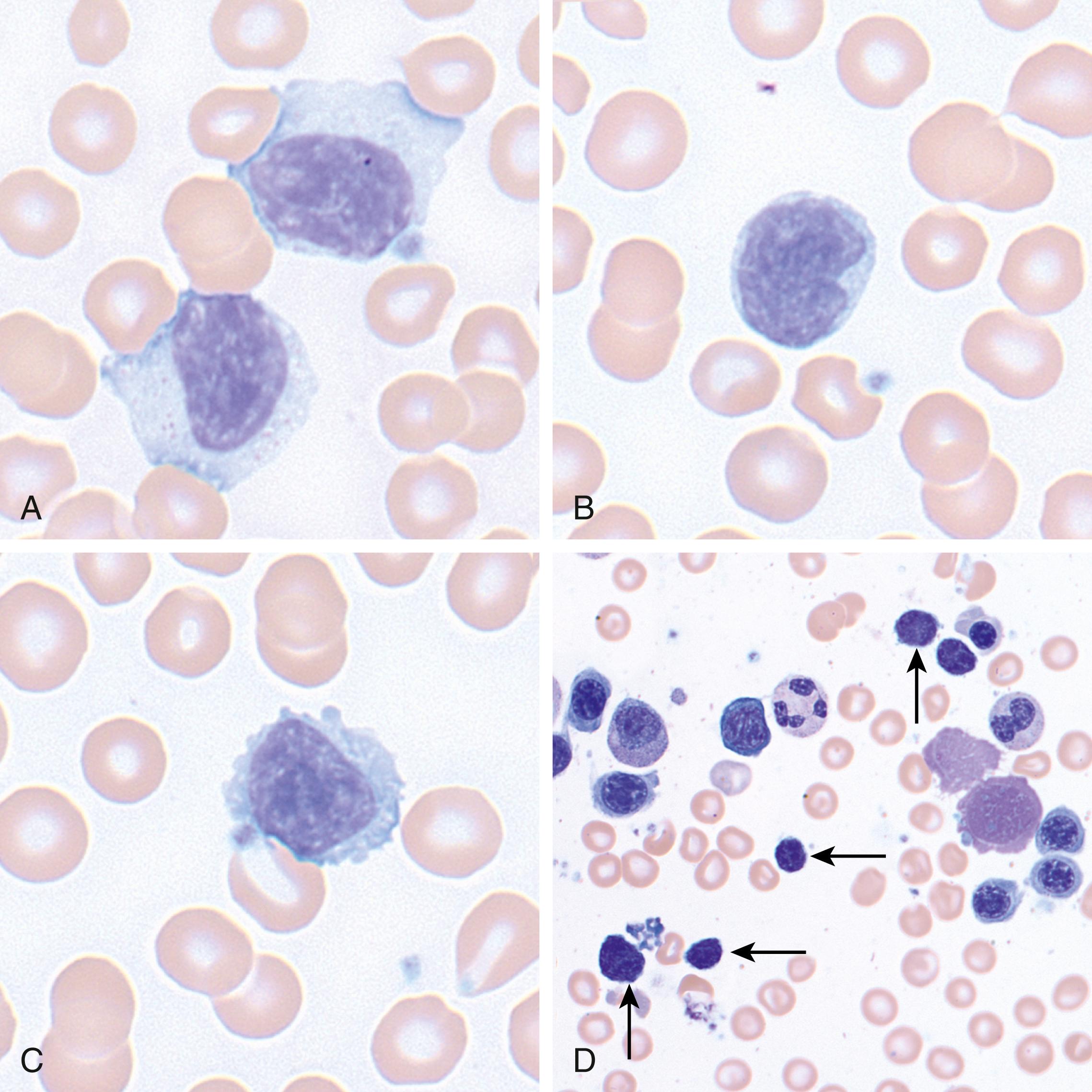 Fig. 13.4, Chronic lymphoproliferative disorder of natural killer cells (CLD-NK). (A–C) Peripheral blood examples of neoplastic large granular lymphocytes (LGLs) seen in CLD-NK. (A) Two LGLs with large nuclei showing more open chromatin; azurophilic granules can be seen in the cytoplasm of these cells. (B) An LGL in a case of CLD-NK with a large nucleus, distinct nucleolus, and modest amounts of finely granular cytoplasm. (C) An LGL in a case of CLD-NK with an enlarged nucleus and moderate amounts of finely granular cytoplasm; this LGL showed blebbing that can be seen in a subset of cases. (D) A bone marrow aspirate specimen involved by CLD-NK with LGLs (noted by arrows ). In bone marrow aspirate specimens, LGLs typically do not show large amounts of cytoplasm and cytoplasmic granules may be difficult to see.