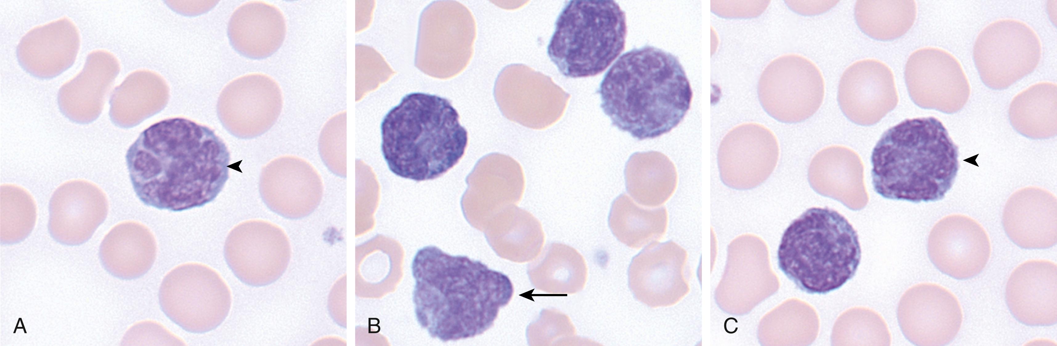 Fig. 13.5, Adult T-cell leukemia/lymphoma (ATLL). (A–C) Peripheral blood examples of neoplastic cells in ATLL. (A) A medium to large neoplastic “flower cell” cell in ATLL is seen ( arrowhead ); note how the nucleus shows a similar appearance to the head of a flower, and the nuclear lobulations are akin to the petals of a flower. (B) A second example of neoplastic cells in ATLL with medium-sized cells with irregular nuclear borders; one cell shows rounded cytoplasmic extrusions ( arrow ). (C) A third example of neoplastic cells in ATLL with a flower cell adjacent to another neoplastic cell with irregular nuclear membranes ( arrow ).