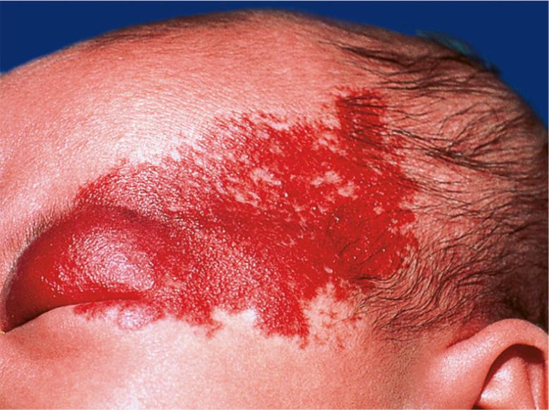 Fig. 103.2, Superficial infantile hemangioma mimicking a capillary malformation.