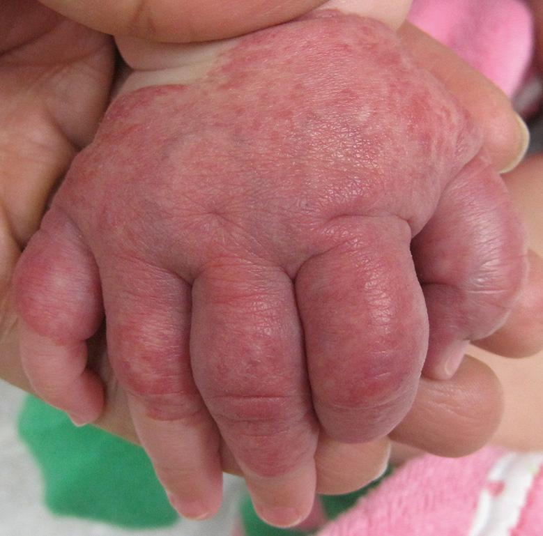 Fig. 103.6, “Biker glove” pattern of an acral infantile hemangioma with minimal or arrested growth.