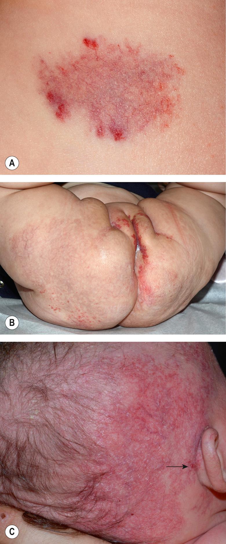 Fig. 103.8, Infantile hemangiomas with minimal or arrested growth (IH-MAG).