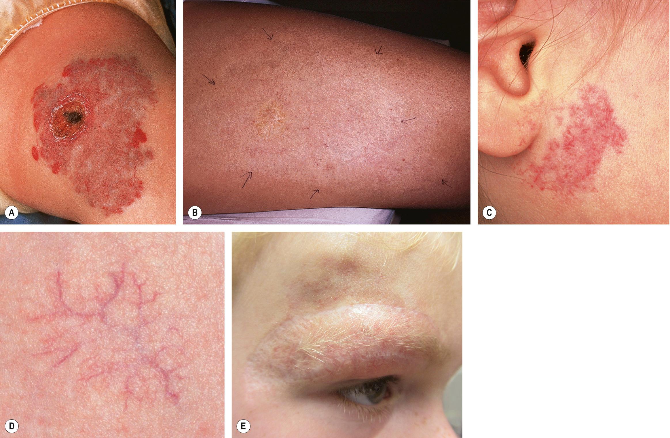 Fig. 103.10, Residua of infantile hemangiomas.