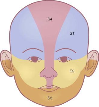 Figure 21.2, Distribution patterns of segmental hemangiomas on the face.