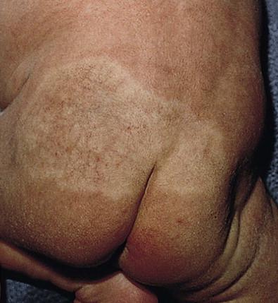 Figure 21.3, A hemangioma precursor presenting as a vasoconstricted patch.