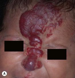 Figure 21.4, (A) This frontonasal (S4) and lower lip (S3) segmental hemangioma grew significantly by 7 weeks of age. (B) After 6 months of therapy with propranolol there was a significant decrease in color intensity and bulk, leaving residual atrophic skin changes that were most prominent in areas that corresponded to most exophytic portions of the hemangioma.