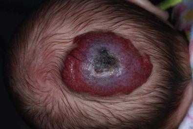 Figure 21.7, Hemangioma on the scalp with painful ulceration.