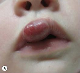 Figure 21.8, Hemangioma locations associated with a high risk for disfigurement including the (A) lip, (B) ear, (C) nose, and (D) forehead.