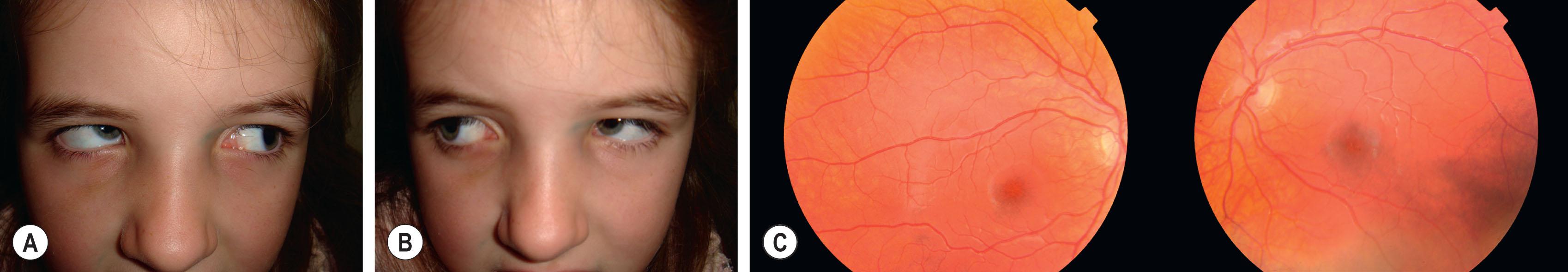 Fig. 77.6, Right IOOA (A), left IOOA (B), and fundus excyclotorsion (C) in the same patient. Note the fovea lies below a line passing through the inferior edge of the optic discs.