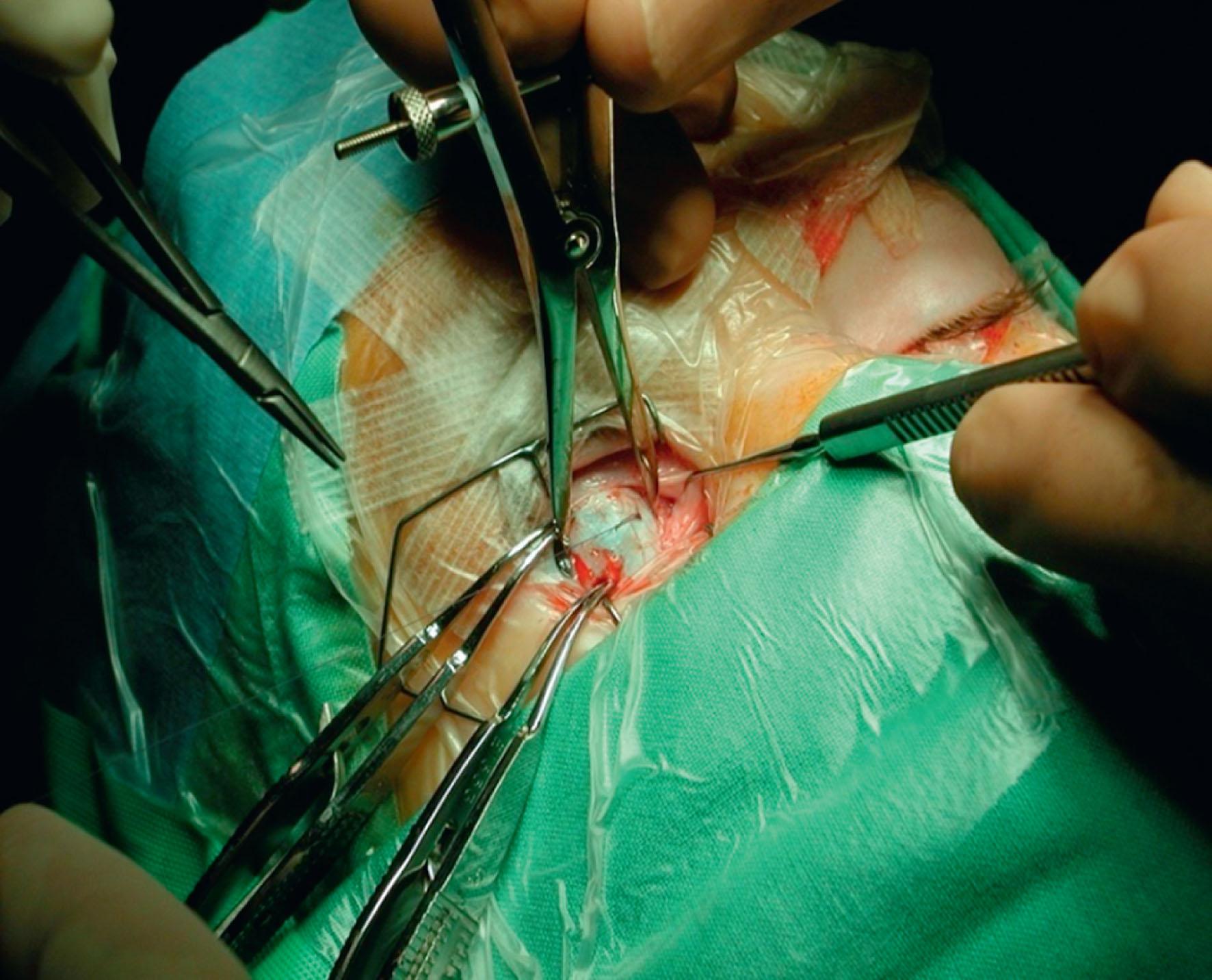 Fig. 77.7, Measurement of right medial rectus recession 11 mm from the limbus. Left arm of caliper at 3 o'clock position on limbus. Note infantile type insertion approximately 3 mm from limbus. (Measurement technique is described by Camuglia et al. 43 )