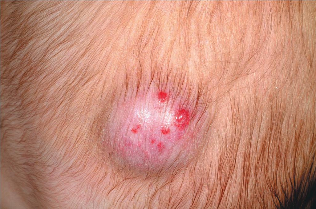 Fig. 12.11, Combined hemangioma. This lesion is predominantly deep, with studding of the surface with small, superficial components.