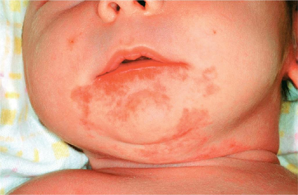 Fig. 12.12, Hemangioma precursor, telangiectasias. This lesion might initially be diagnosed as a port wine stain; within 4 weeks it was thickening, with eventual ulceration of the lip.