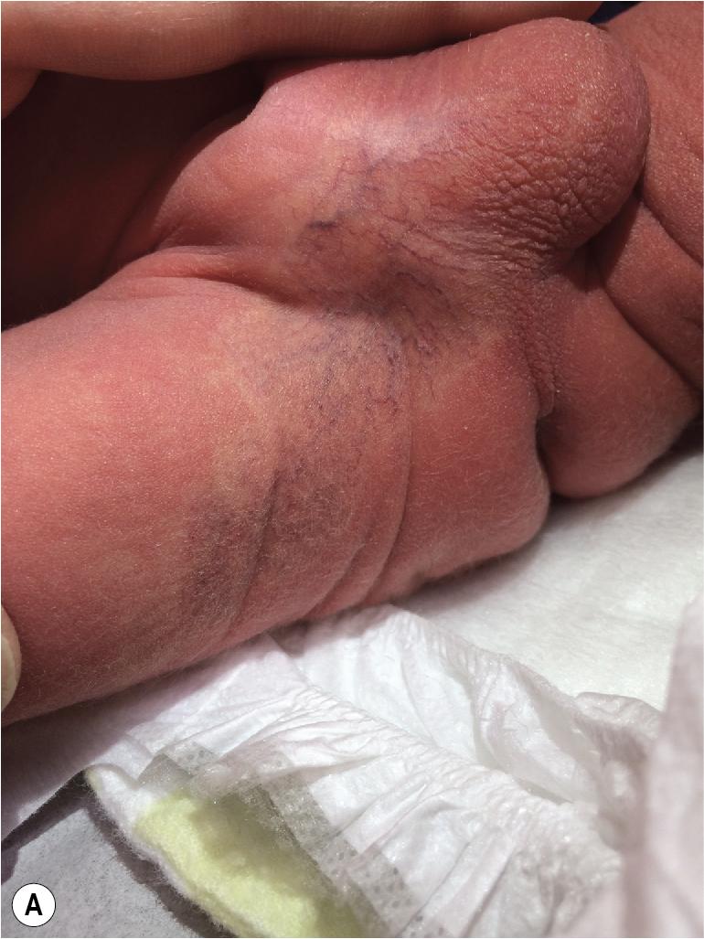 Fig. 12.13, Hemangioma precursor, pallor and telangiectasias. This 2-day-old boy presented with a vasoconstricted patch (pallor) with telangiectasias (A) . Follow-up evaluation at 2.5 weeks of age revealed changes consistent with proliferative infantile hemangioma (B) .