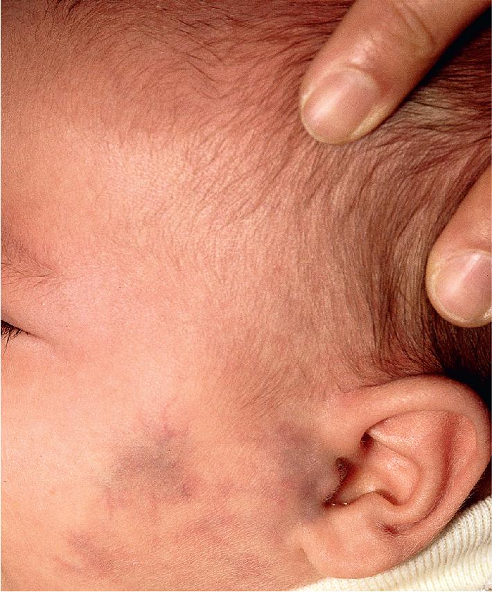 Fig. 12.14, Hemangioma precursor, ecchymosis. This bruise-like appearance may be seen before hemangioma proliferation occurs.