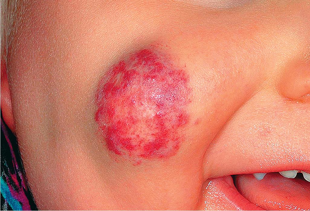 Fig. 12.17, Hemangioma, involution phase. Note the patchy vascular appearance in this involuting lesion in a 2-year-old boy.