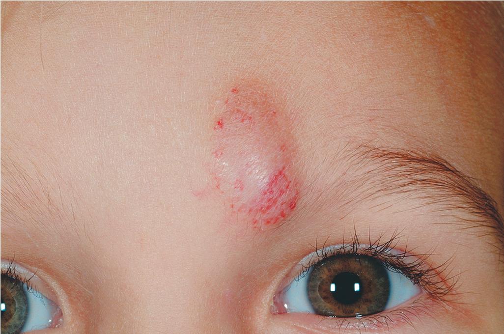 Fig. 12.18, Hemangioma, involution phase. The redness has largely resolved and the lesion flattened in this 3-year-old female.