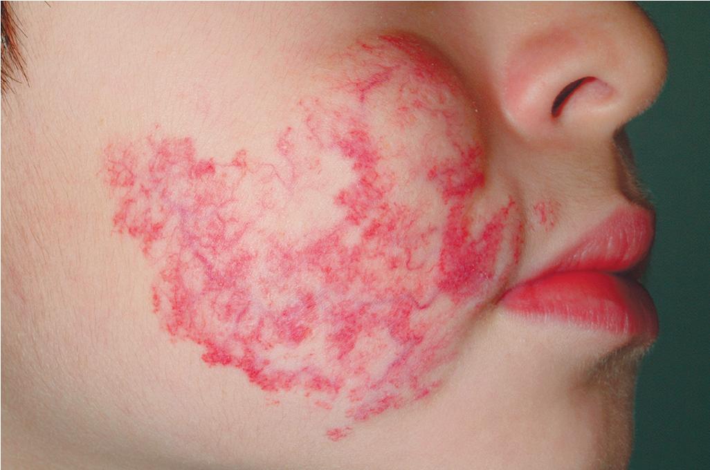 Fig. 12.19, Hemangioma, involuted. This lesion demonstrates the residual telangiectasias that may persist after involution of the hemangioma.