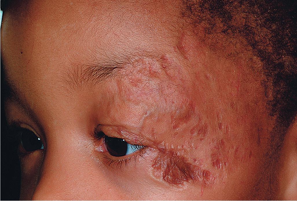 Fig. 12.20, Hemangioma, involuted. This hemangioma was very large with complete obstruction of the visual axis and secondary ulceration. After involution, atrophy and scarring are both evident.